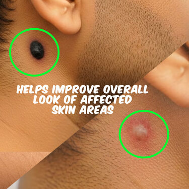 Massa Remover Gel (BCMR)